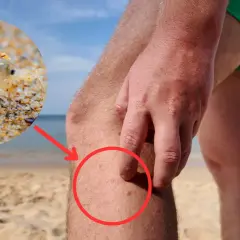 Gros plan sur une puce des sables sur le sable, avec une flèche rouge pointant vers des piqûres sur une jambe humaine.