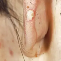 Gros plan sur une oreille montrant une lésion de calcinose sous cutanée, blanche et légèrement surélevée, avec une petite lésion brune à proximité.
