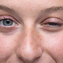 Gros plan sur le visage d'une femme, montrant un œil ouvert et un œil mi-clos, possiblement lié à la myasthénie. L'espérance de vie avec cette condition varie.