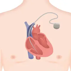 Illustration d'un défibrillateur implantable dans le thorax, près du cœur. Les effets secondaires potentiels sont une préoccupation.