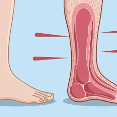 Illustration d'un pied sain et d'une coupe transversale montrant les structures internes, possiblement pour expliquer la maladie de Charcot pied.