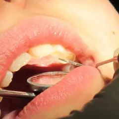 Un dentiste utilise des instruments pour examiner et potentiellement faire repousser les dents d'un patient.