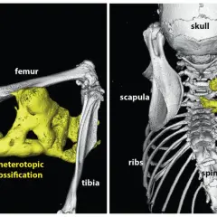 Imagerie 3D montrant une fibrodysplasie ossifiante progressive avec ossification hétérotopique jaune autour du fémur, du tibia et de la colonne vertébrale.