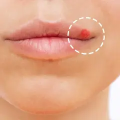 Gros plan sur une bouche avec un bouton rouge vif sur la lèvre supérieure, entouré d'un cercle pointillé.
