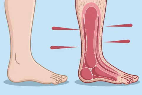 Illustration d'un pied sain et d'une coupe transversale montrant les structures internes, possiblement pour expliquer la maladie de Charcot pied.