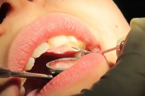 Un dentiste utilise des instruments pour examiner et potentiellement faire repousser les dents d'un patient.