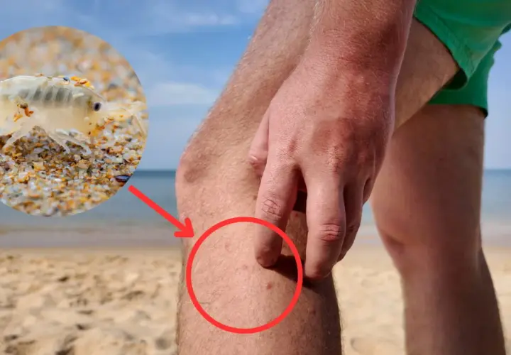 Gros plan sur une puce des sables sur le sable, avec une flèche rouge pointant vers des piqûres sur une jambe humaine.