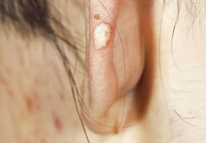 Gros plan sur une oreille montrant une lésion de calcinose sous cutanée, blanche et légèrement surélevée, avec une petite lésion brune à proximité.
