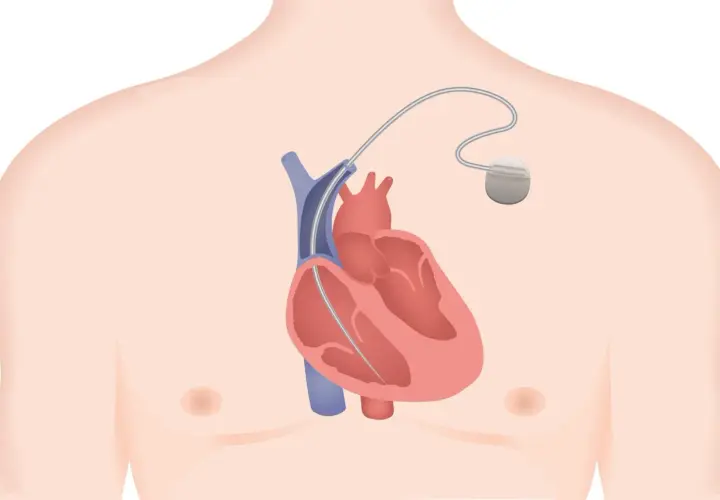 Illustration d'un défibrillateur implantable dans le thorax, près du cœur. Les effets secondaires potentiels sont une préoccupation.