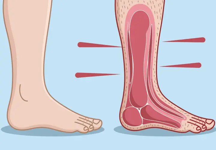Illustration d'un pied sain et d'une coupe transversale montrant les structures internes, possiblement pour expliquer la maladie de Charcot pied.