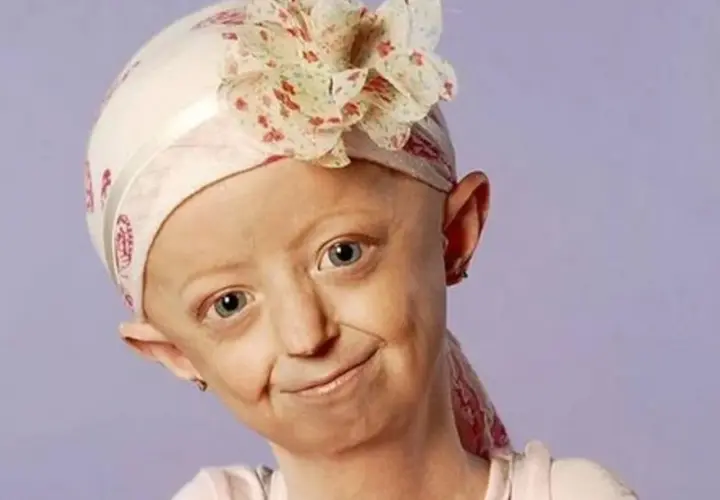 Jeune fille souriante portant un foulard fleuri, atteinte du syndrome de Hutchinson-Gilford.