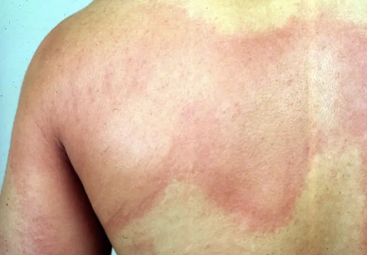 Éruption cutanée rouge sur le dos, possiblement une maladie en o. La peau présente des zones enflammées et des rougeurs diffuses.