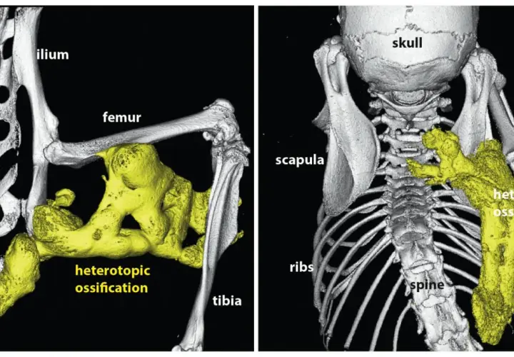 Imagerie 3D montrant une fibrodysplasie ossifiante progressive avec ossification hétérotopique jaune autour du fémur, du tibia et de la colonne vertébrale.