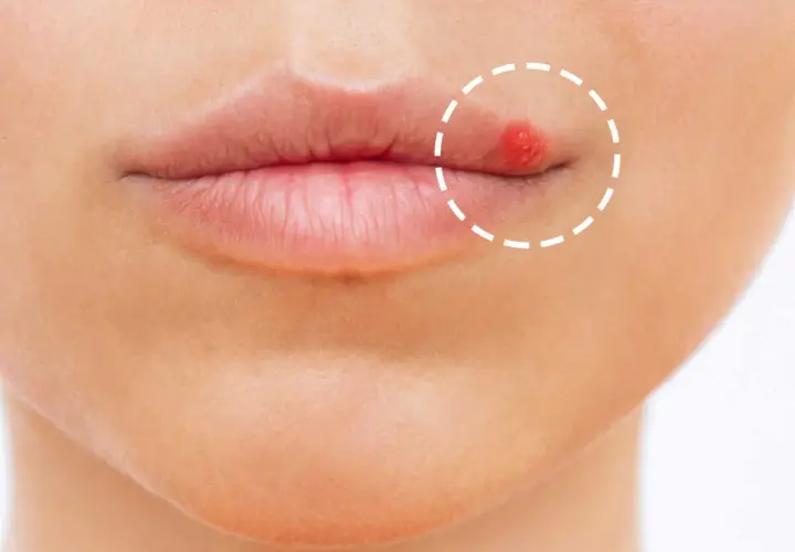 Gros plan sur une bouche avec un bouton rouge vif sur la lèvre supérieure, entouré d'un cercle pointillé.