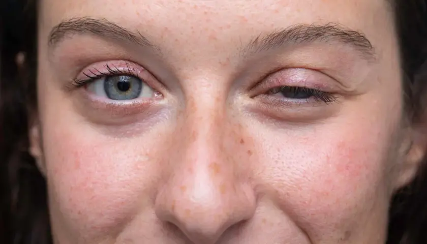 Gros plan sur le visage d'une femme, montrant un œil ouvert et un œil mi-clos, possiblement lié à la myasthénie. L'espérance de vie avec cette condition varie.