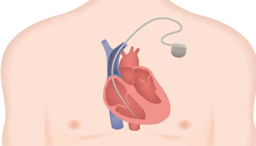 Illustration d'un défibrillateur implantable dans le thorax, près du cœur. Les effets secondaires potentiels sont une préoccupation.