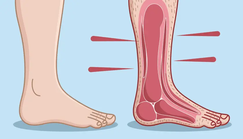 Illustration d'un pied sain et d'une coupe transversale montrant les structures internes, possiblement pour expliquer la maladie de Charcot pied.