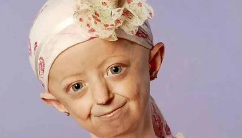Jeune fille souriante portant un foulard fleuri, atteinte du syndrome de Hutchinson-Gilford.