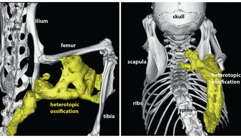 Imagerie 3D montrant une fibrodysplasie ossifiante progressive avec ossification hétérotopique jaune autour du fémur, du tibia et de la colonne vertébrale.