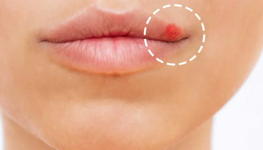 Gros plan sur une bouche avec un bouton rouge vif sur la lèvre supérieure, entouré d'un cercle pointillé.