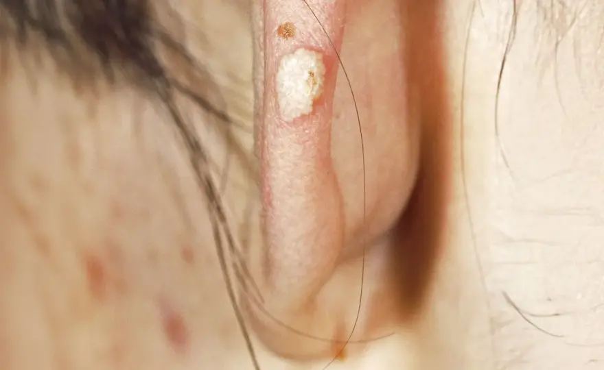Calcinose sous-cutanée - Comprendre et traiter ces dépôts de calcium