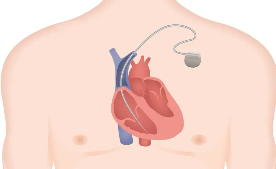 Défibrillateur implantable - Gérer les effets secondaires et chocs
