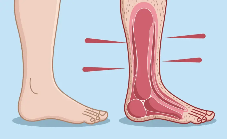 Pied de Charcot: reconnaître les signes pour éviter la déformation
