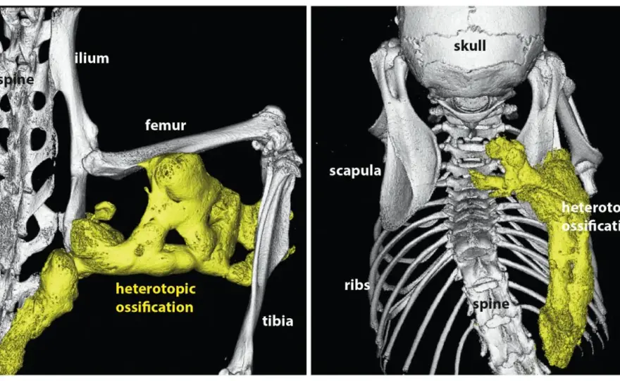 Fibrodysplasie Ossifiante Progressive - Comprendre la FOP