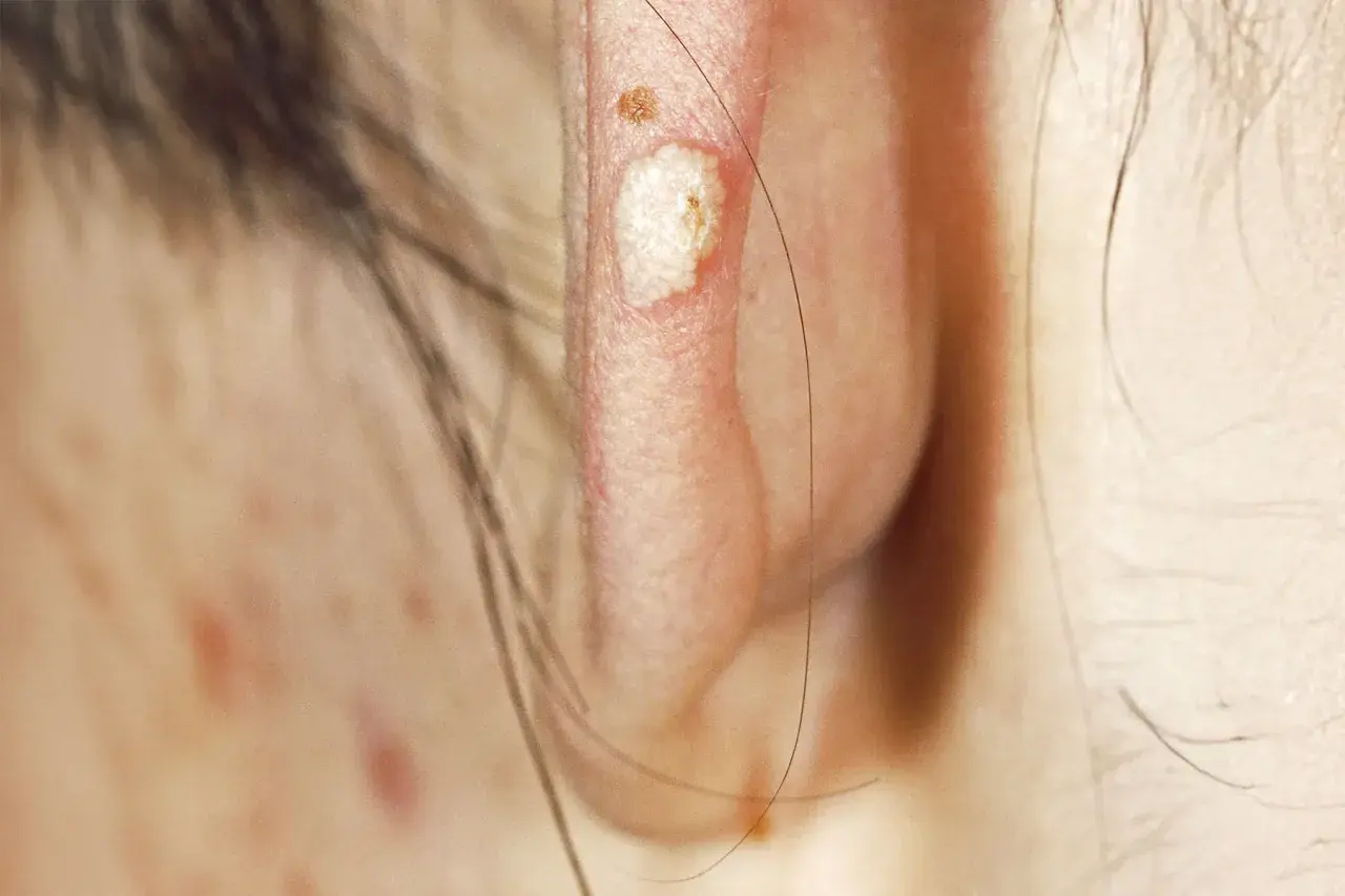 Gros plan sur une oreille montrant une lésion de calcinose sous cutanée, blanche et légèrement surélevée, avec une petite lésion brune à proximité.