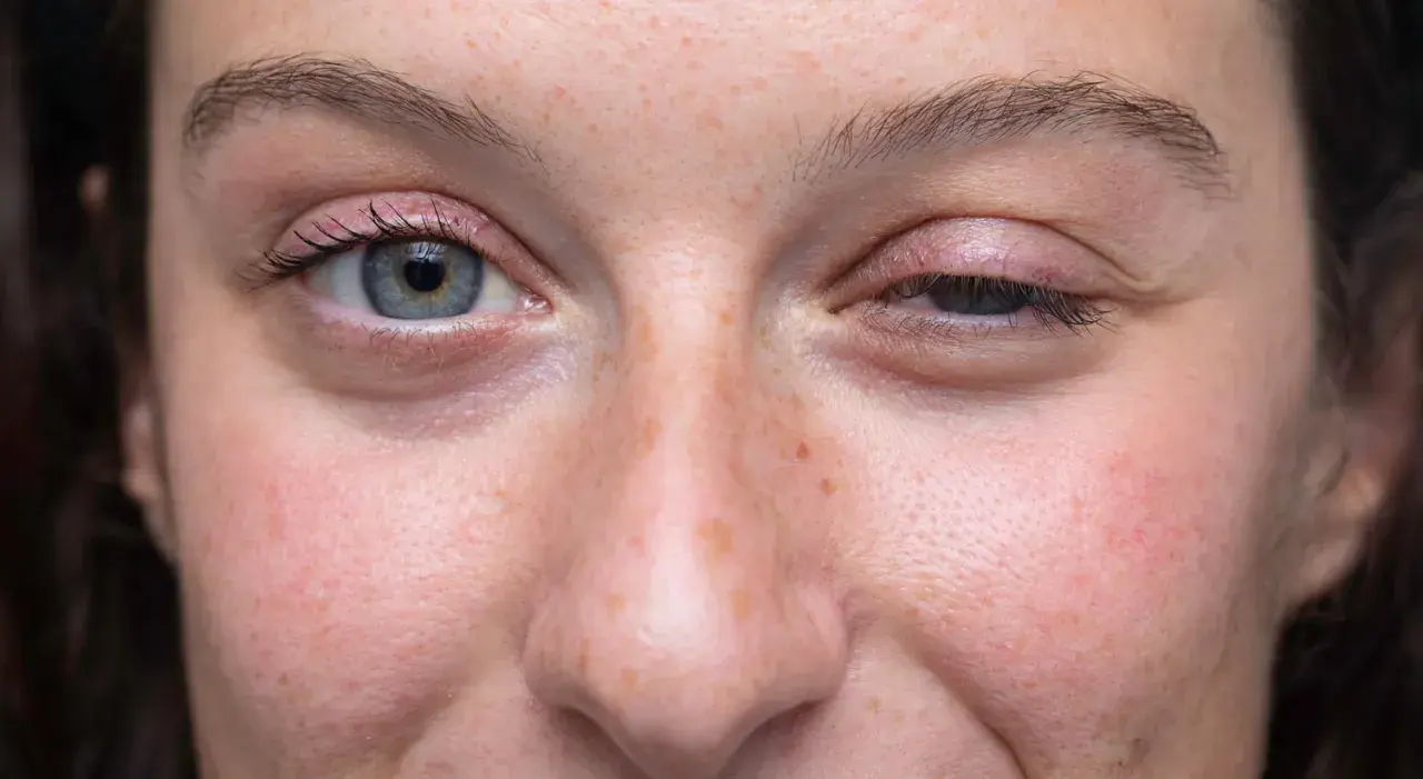 Gros plan sur le visage d'une femme, montrant un œil ouvert et un œil mi-clos, possiblement lié à la myasthénie. L'espérance de vie avec cette condition varie.