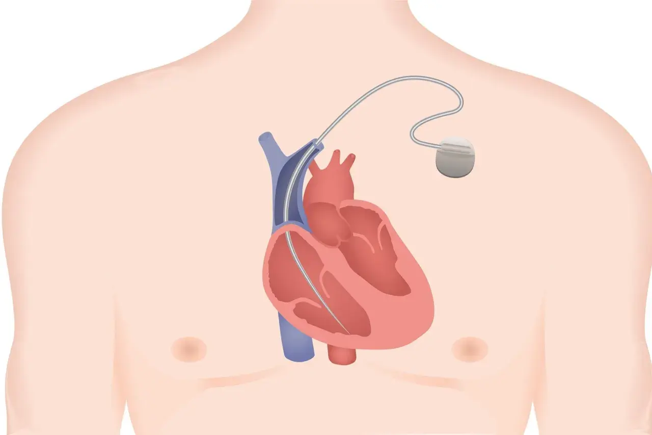 Illustration d'un défibrillateur implantable dans le thorax, près du cœur. Les effets secondaires potentiels sont une préoccupation.
