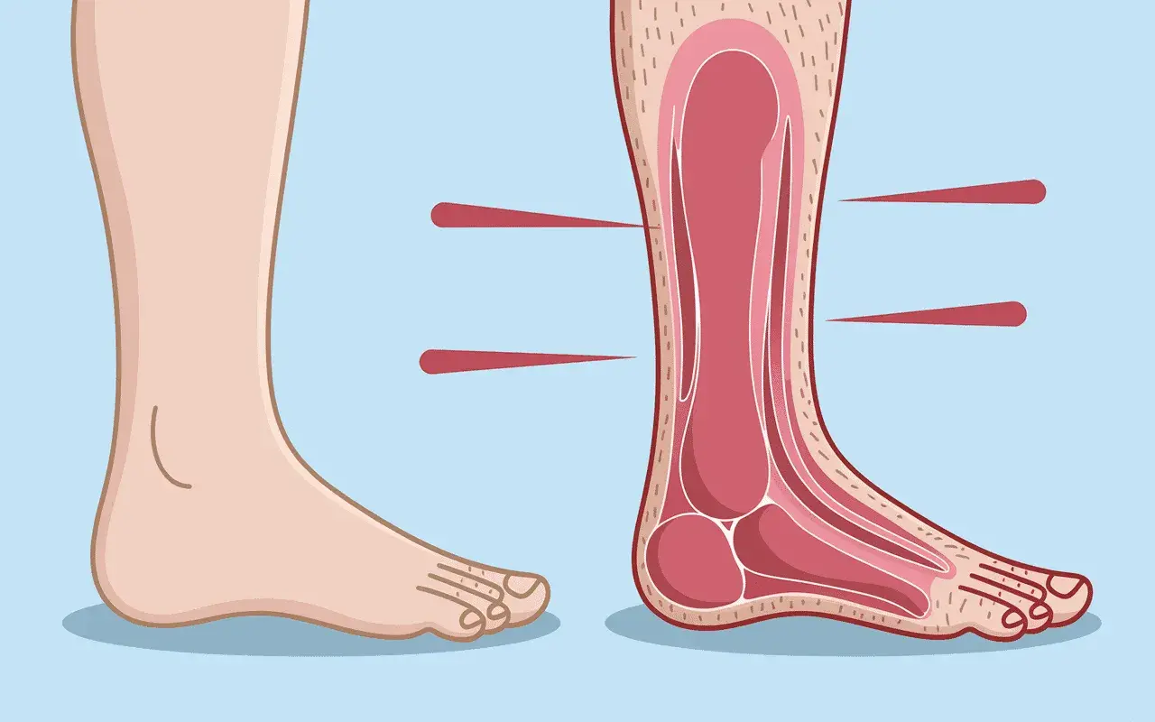 Illustration d'un pied sain et d'une coupe transversale montrant les structures internes, possiblement pour expliquer la maladie de Charcot pied.