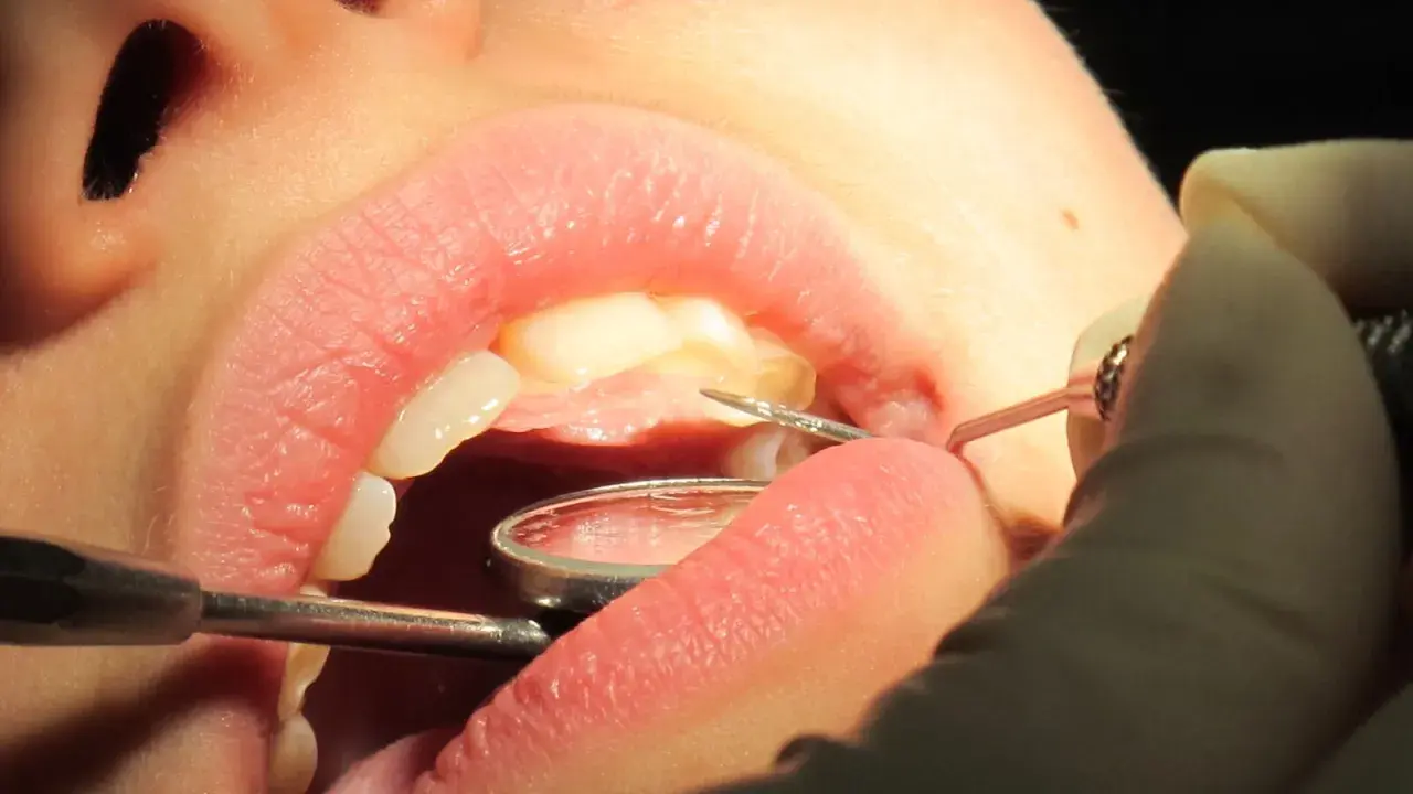 Un dentiste utilise des instruments pour examiner et potentiellement faire repousser les dents d'un patient.