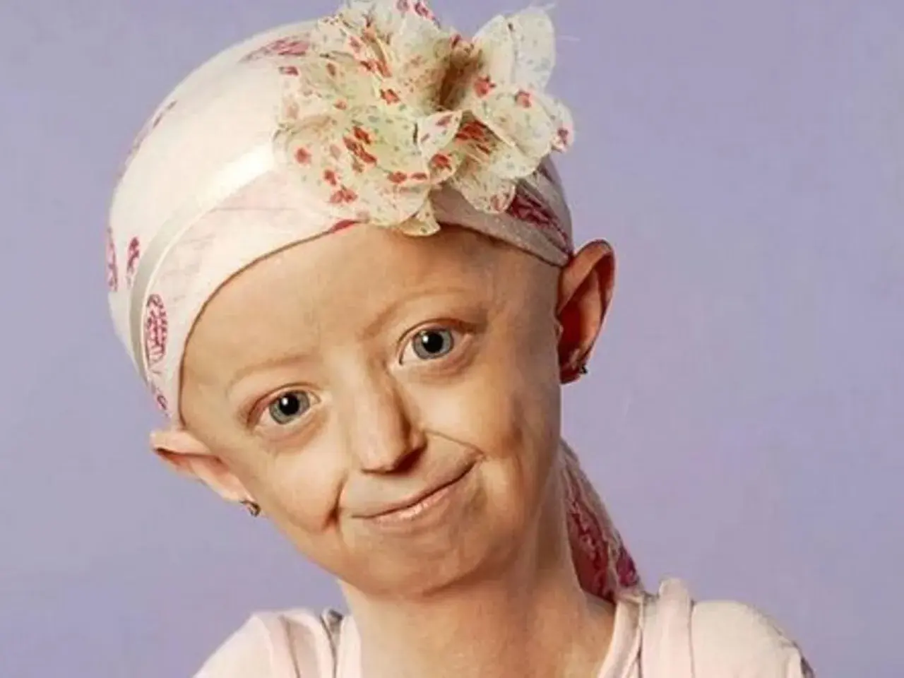 Jeune fille souriante portant un foulard fleuri, atteinte du syndrome de Hutchinson-Gilford.