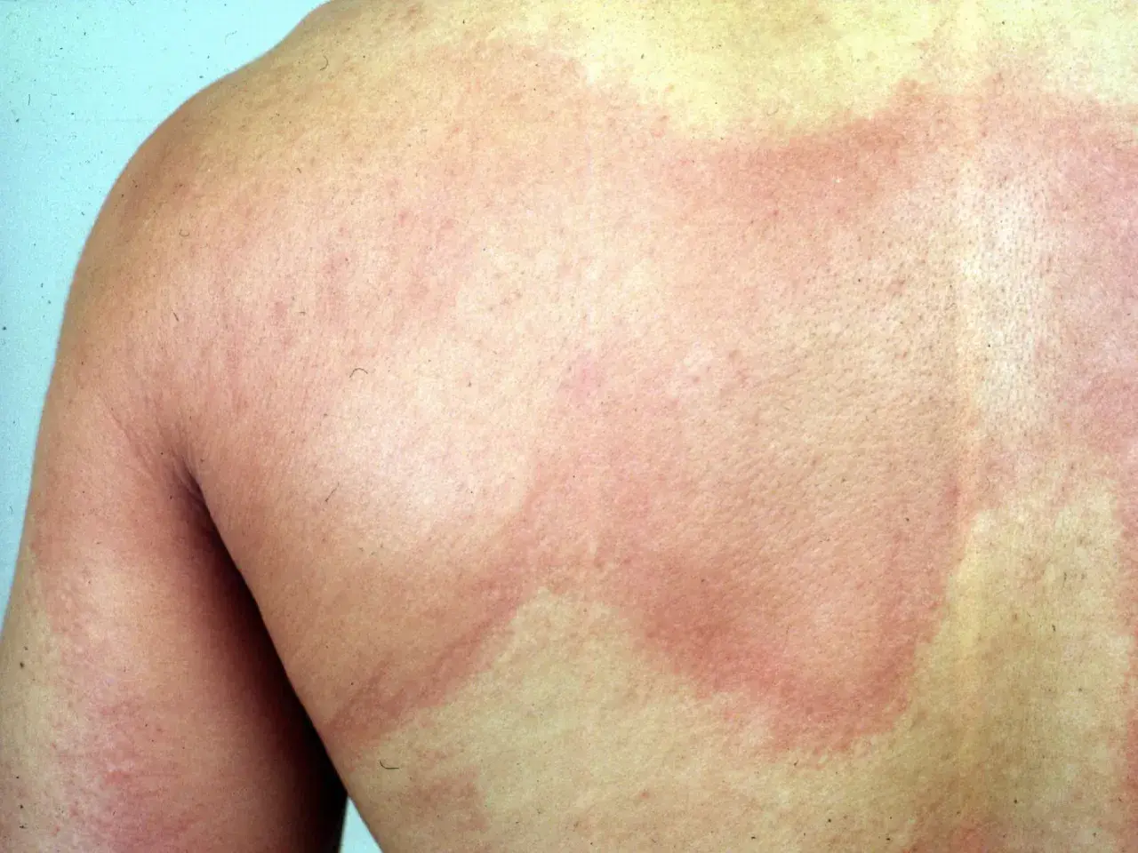 Éruption cutanée rouge sur le dos, possiblement une maladie en o. La peau présente des zones enflammées et des rougeurs diffuses.