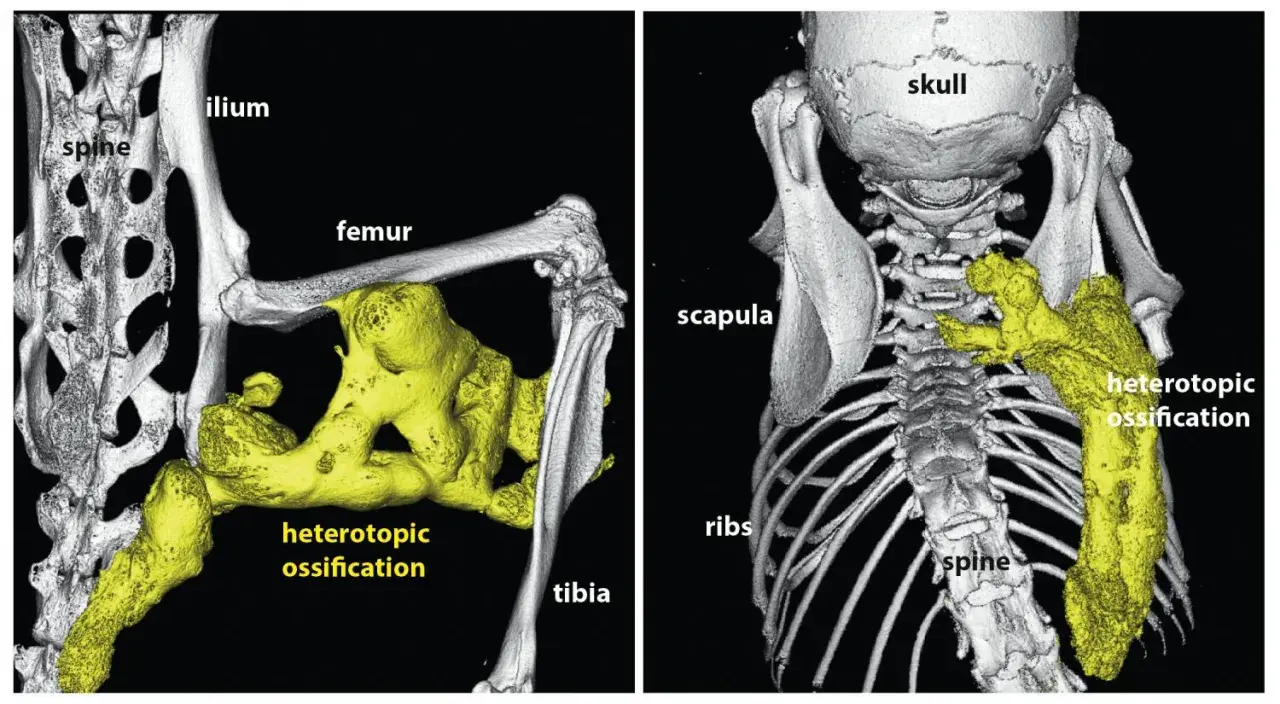Imagerie 3D montrant une fibrodysplasie ossifiante progressive avec ossification hétérotopique jaune autour du fémur, du tibia et de la colonne vertébrale.