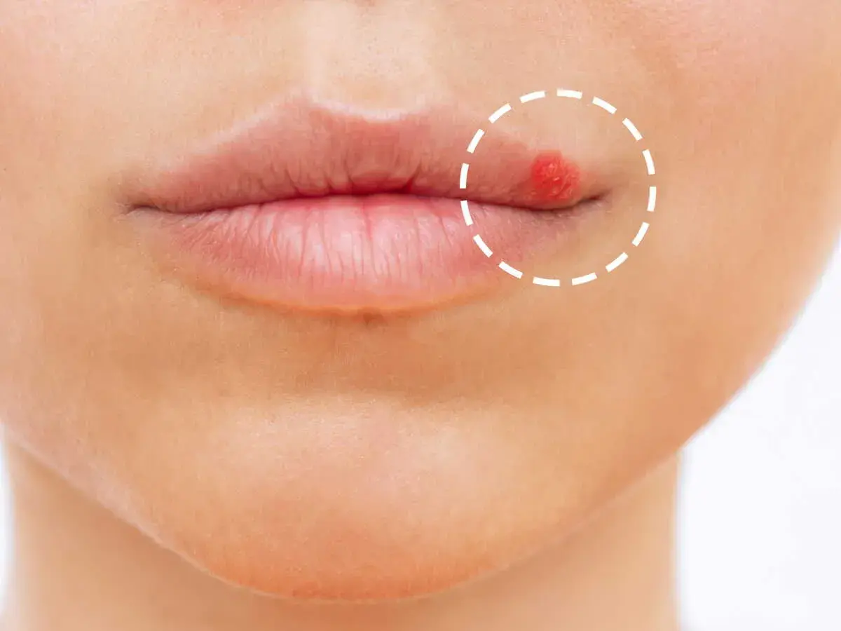 Gros plan sur une bouche avec un bouton rouge vif sur la lèvre supérieure, entouré d'un cercle pointillé.