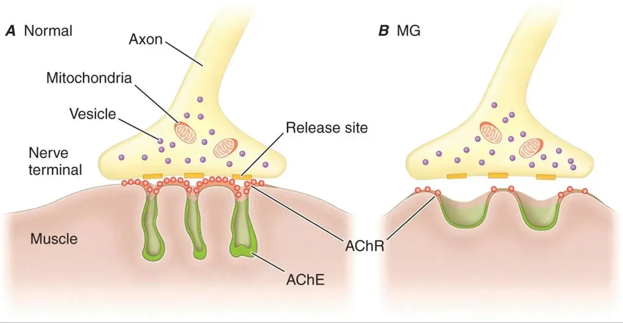 Comparaison d'une synapse normale et d'une synapse atteinte de myasthénie. La myasthénie grave affecte la transmission neuromusculaire, mais l'espérance de vie s'est améliorée.