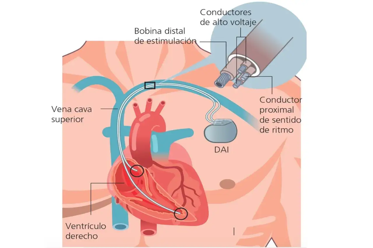 Schéma d'un DAI implanté dans le cœur. Il est possible de mourir avec un défibrillateur implanté, mais il est conçu pour prévenir les arrêts cardiaques.