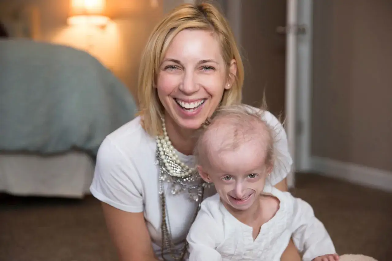 Une femme souriante tient un enfant atteint du syndrome de Hutchinson-Gilford. L'enfant a un visage fin et des cheveux rares.