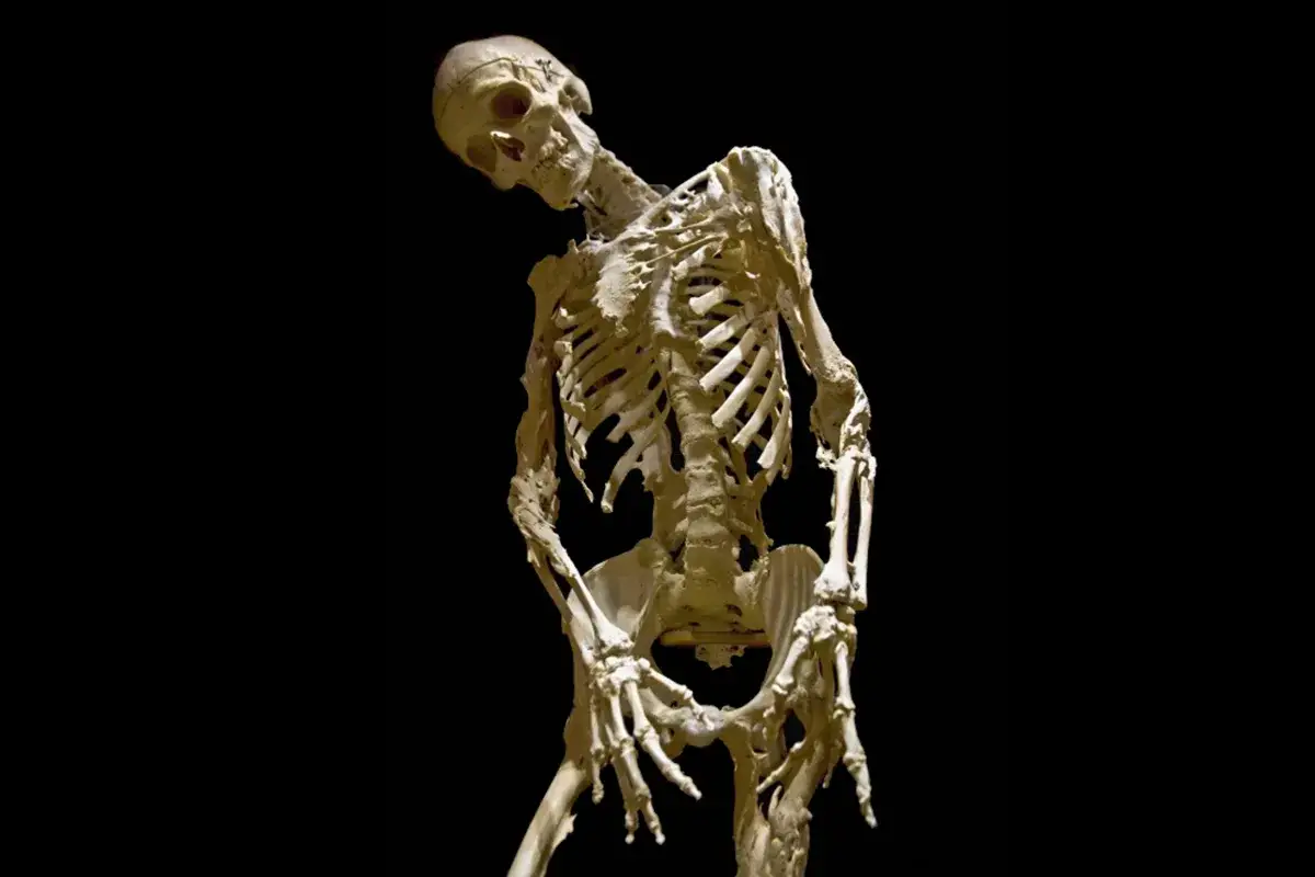 Squelette humain aux membres tordus, évoquant la fibrodysplasie ossifiante progressive.