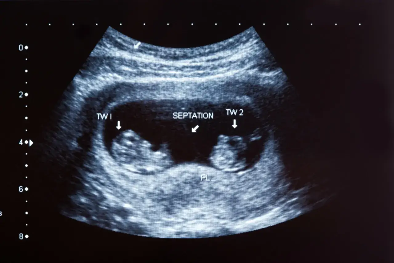 Échographie montrant deux fœtus, TW 1 et TW 2, séparés par une septation. Une belle surprise, des jumeaux cachés !