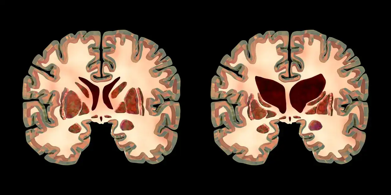 Comparaison de cerveaux : à gauche, un cerveau sain ; à droite, un cerveau atteint de la maladie de Huntington, montrant une atrophie qui affecte l'espérance de vie.