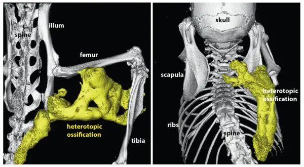 Imagerie 3D montrant une fibrodysplasie ossifiante progressive avec ossification hétérotopique jaune autour du fémur, du tibia et de la colonne vertébrale.
